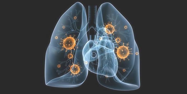 infected lungs of corona virus